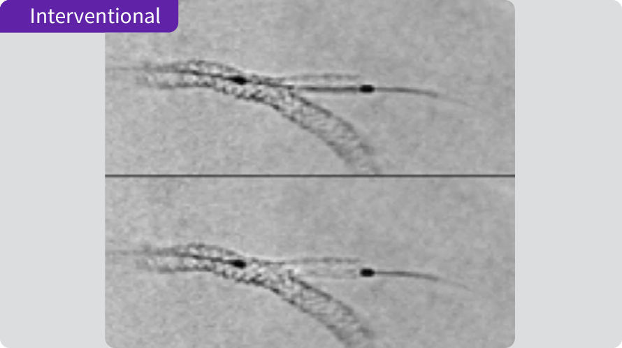 Interventional Benefits of QFR PCI ASSIST