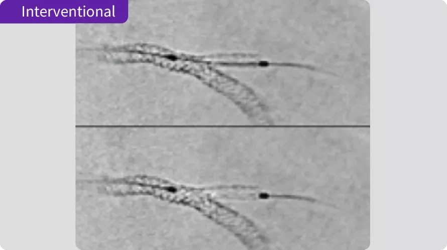 Interventional Benefits of QFR PCI ASSIST