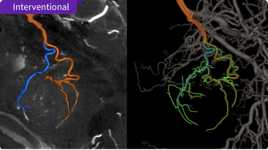 Interventional -Embo ASSIST AI