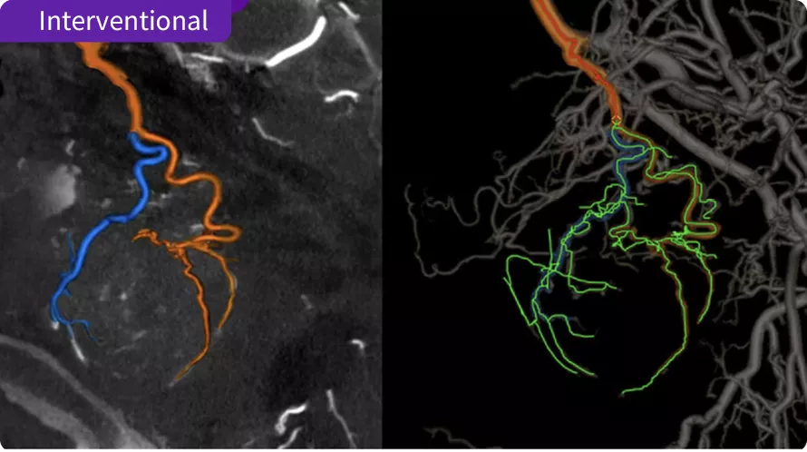 Interventional -Embo ASSIST AI