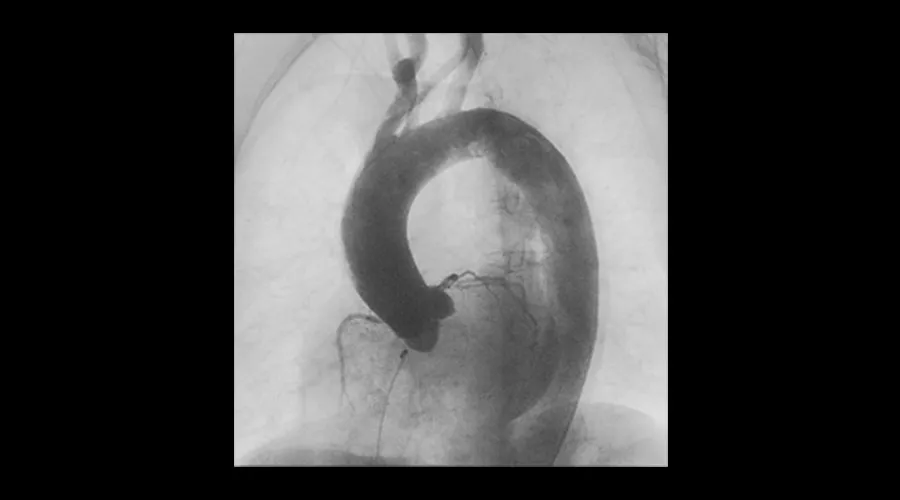 interventional-x-ray-igs-for-interventional-cardiology-330-aortic-procedures