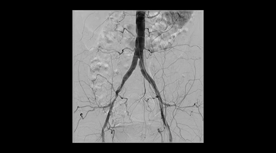 interventional-x-ray-igs-for-interventional-cardiology-330-iliac-stenting