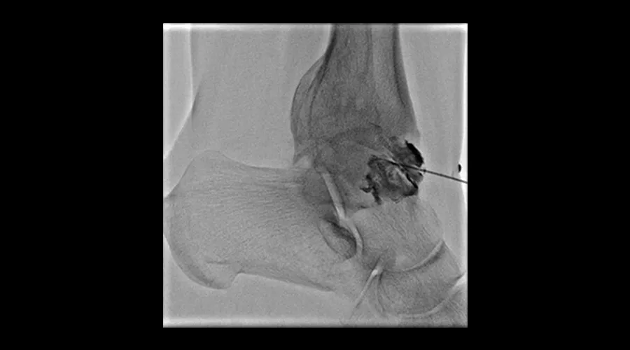 interventional-x-ray-igs-for-interventional-cardiology-330-infiltration-treatment