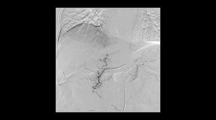 interventional-x-ray-igs-for-interventional-cardiology-330-liverembolization
