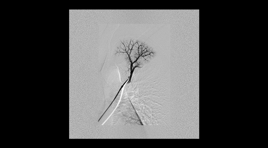 interventional-x-ray-igs-for-interventional-cardiology-330-lung-embolization