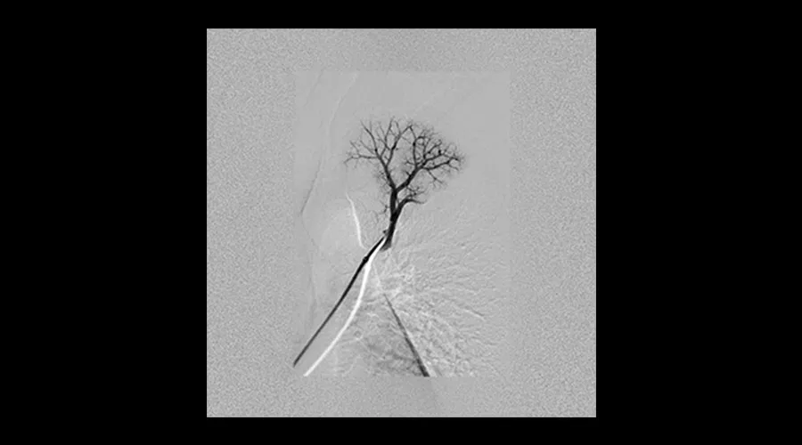 interventional-x-ray-igs-for-interventional-cardiology-330-lung-embolization