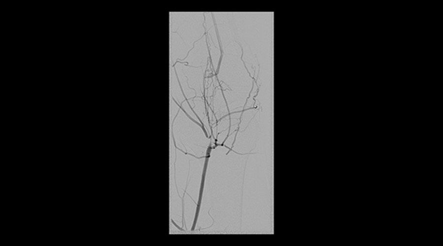 interventional-x-ray-igs-for-interventional-cardiology-330-peripheral-acquisition