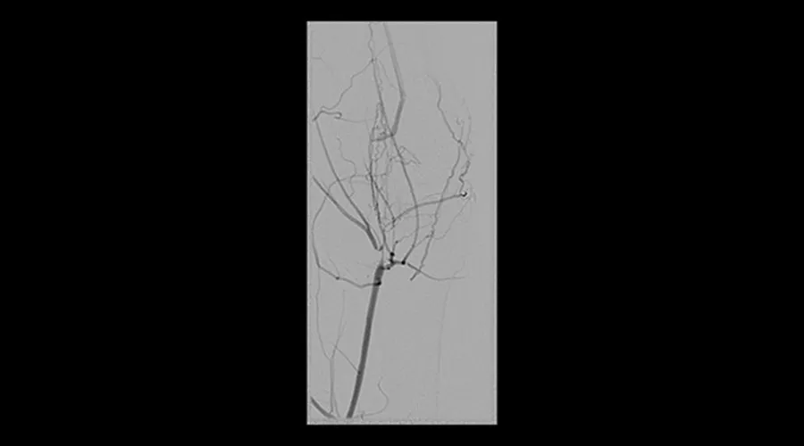 interventional-x-ray-igs-for-interventional-cardiology-330-peripheral-acquisition
