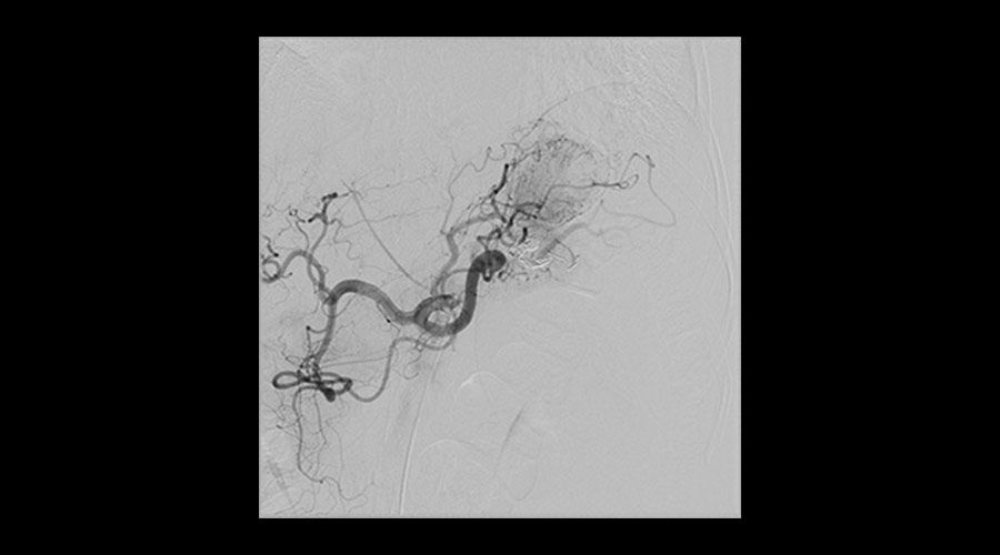 interventional-x-ray-igs-for-interventional-cardiology-330-splenic-aneurysm-treatment
