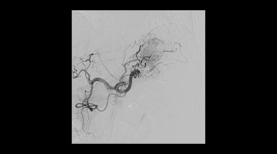 interventional-x-ray-igs-for-interventional-cardiology-330-splenic-aneurysm-treatment