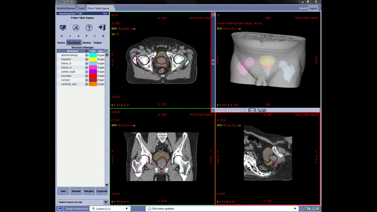 ization-applications-advantagesim-md-gehc-advantagesim-md-ct-atlas-segmentation-pelvis