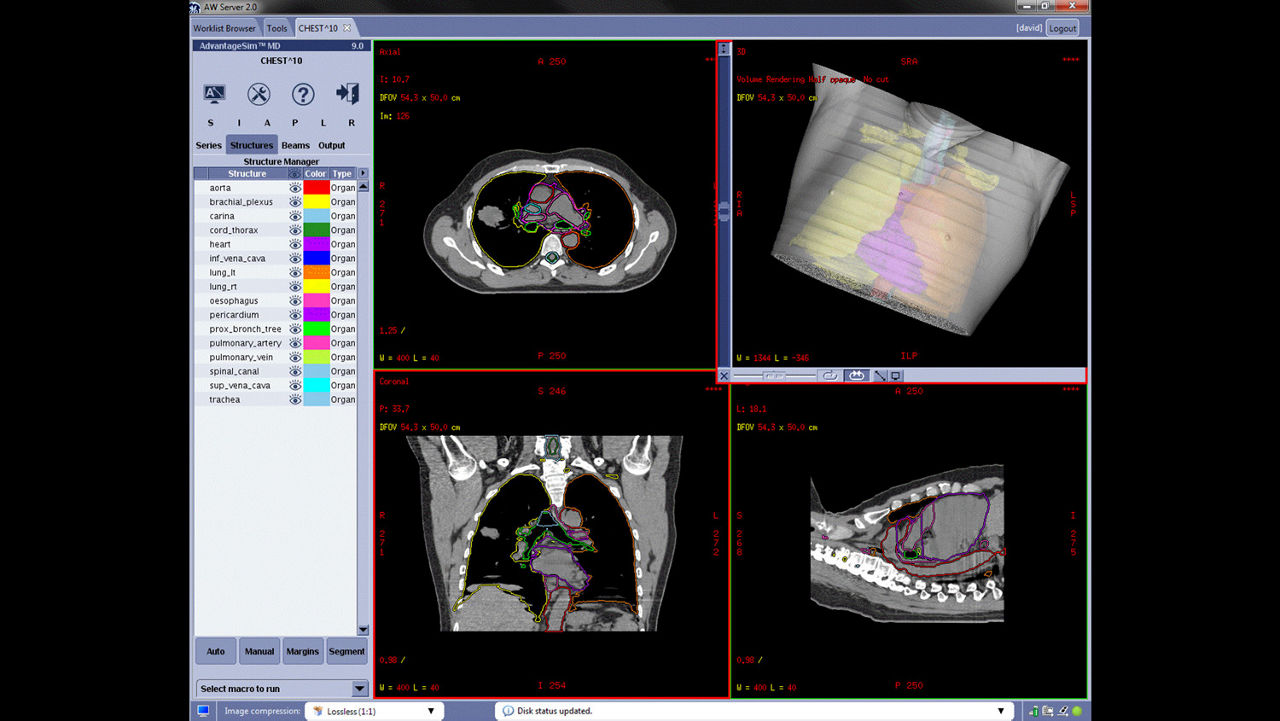 ization-applications-advantagesim-md-gehc-advantagesim-md-ct-atlas-segmentation-thorax