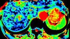 visualização avançada de tc no perfusion 4d multi-organs.