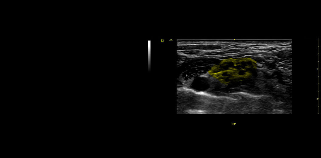 L4-20-t BP-Supraclavicular-cNerve-desktop