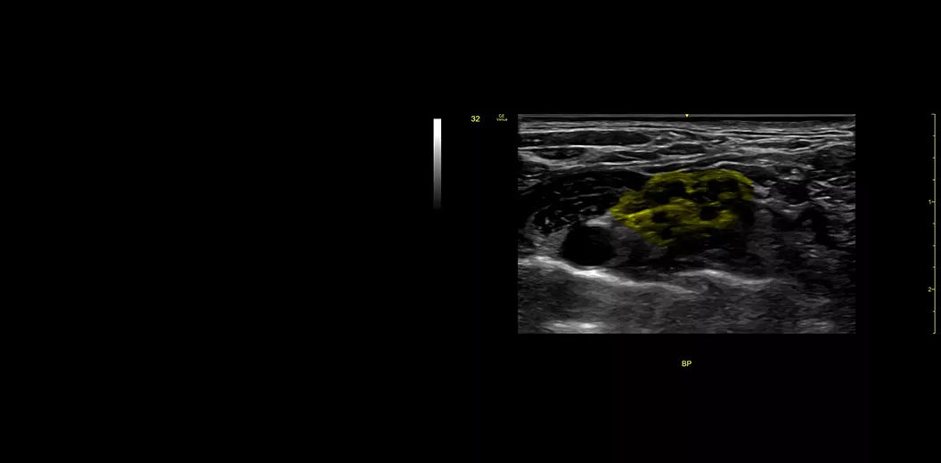 L4-20-t BP-Supraclavicular-cNerve-desktop