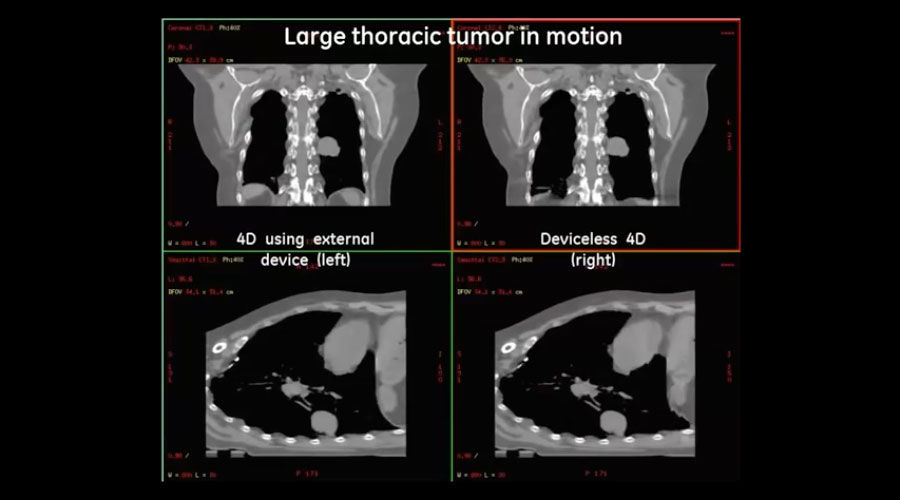 Large-Thoracic-Tumor-in-Motion