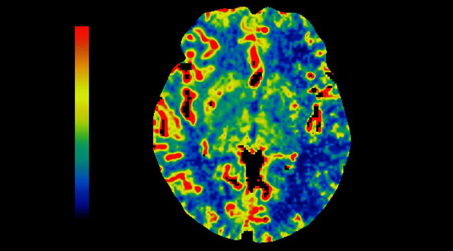 lications-ct-perfusion-4d-multi-organs-aw-ct-perfusion-4d-multi-organ-clinical-image-1
