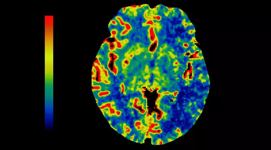 lications-ct-perfusion-4d-multi-organs-aw-ct-perfusion-4d-multi-organ-clinical-image-1