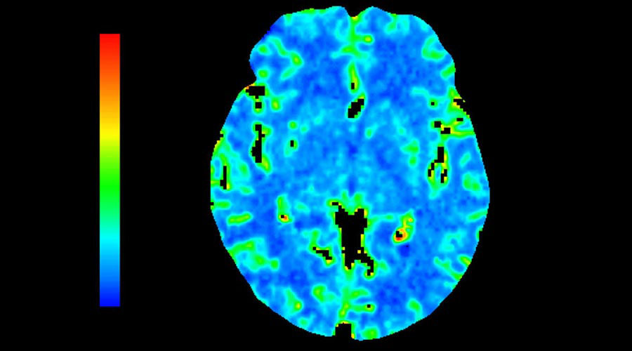 lications-ct-perfusion-4d-multi-organs-aw-ct-perfusion-4d-multi-organ-clinical-image-2