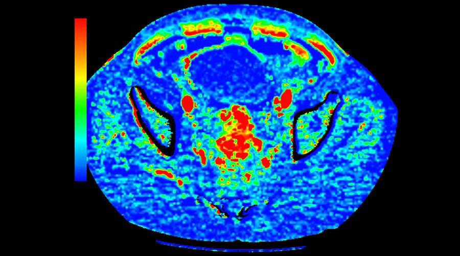 lications-ct-perfusion-4d-multi-organs-aw-ct-perfusion-4d-multi-organ-clinical-image-3