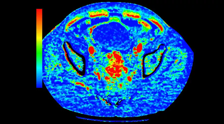 lications-ct-perfusion-4d-multi-organs-aw-ct-perfusion-4d-multi-organ-clinical-image-3