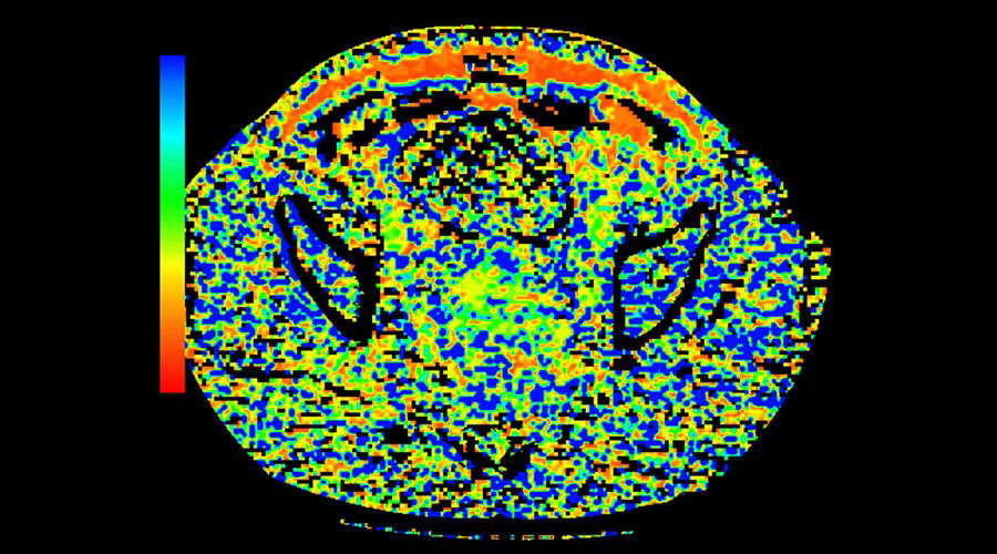 lications-ct-perfusion-4d-multi-organs-aw-ct-perfusion-4d-multi-organ-clinical-image-4