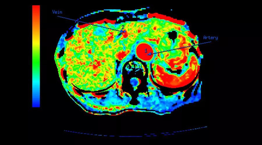 lications-ct-perfusion-4d-multi-organs-aw-ct-perfusion-4d-multi-organ-clinical-image-5