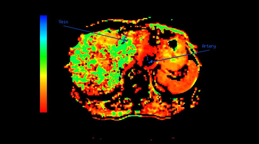 lications-ct-perfusion-4d-multi-organs-aw-ct-perfusion-4d-multi-organ-clinical-image-6