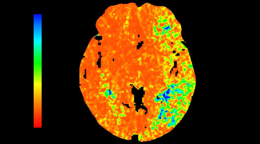 lications-ct-perfusion-4d-multi-organs-aw-ct-perfusion-4d-multi-organ-clinical-image-7