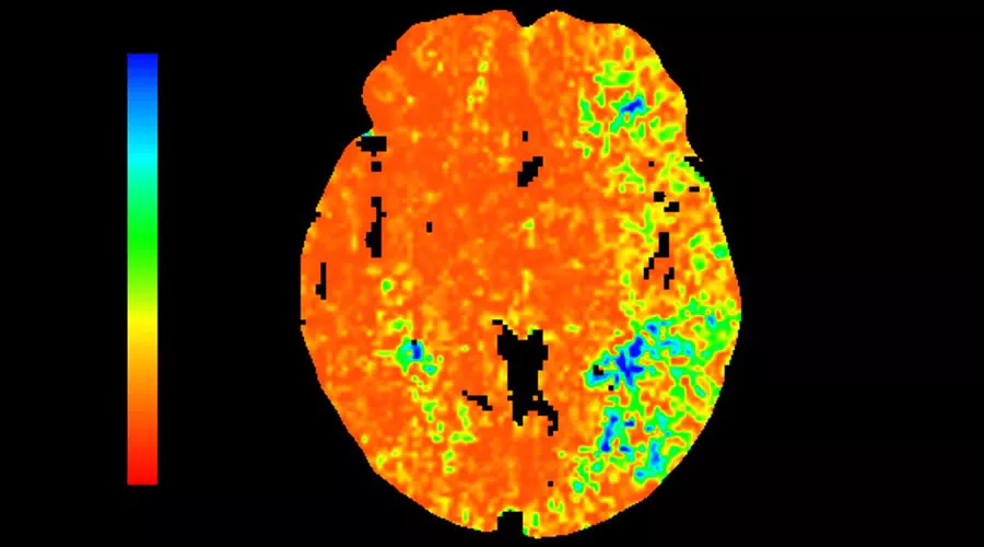 lications-ct-perfusion-4d-multi-organs-aw-ct-perfusion-4d-multi-organ-clinical-image-7