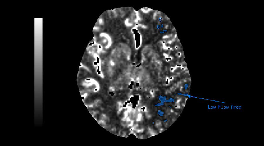lications-ct-perfusion-4d-multi-organs-aw-ct-perfusion-4d-multi-organ-clinical-image-8
