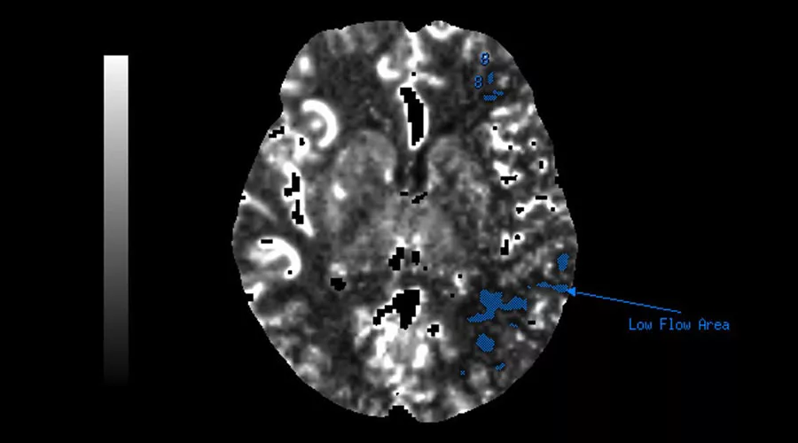 lications-ct-perfusion-4d-multi-organs-aw-ct-perfusion-4d-multi-organ-clinical-image-8