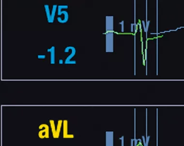 12-lead ST Monitoring