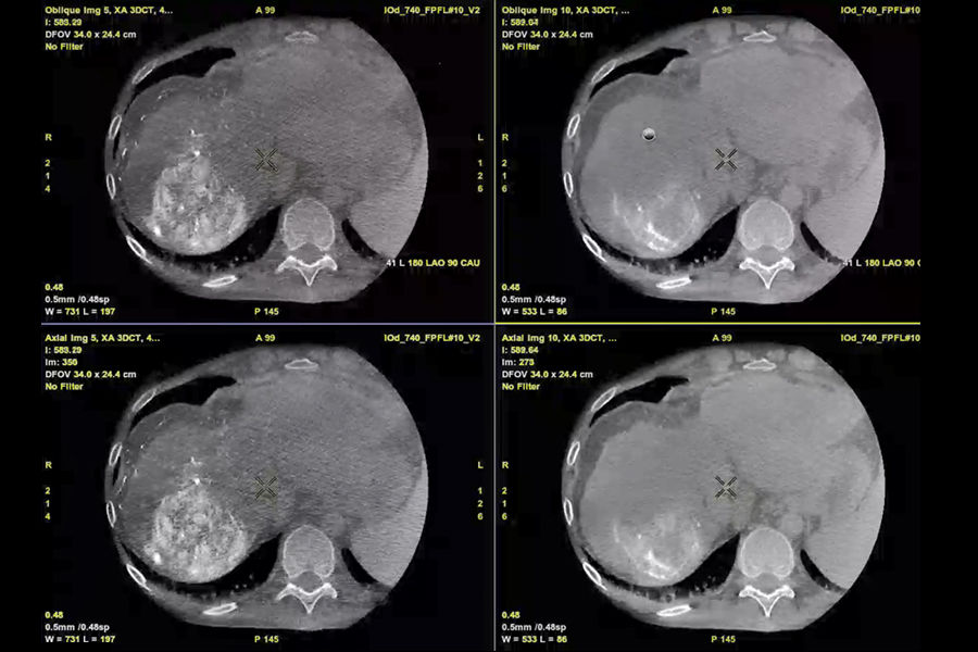liver-assist-virtual-parenchyma-assess