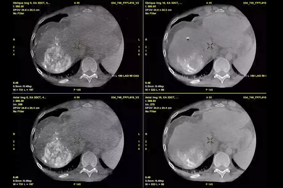 liver-assist-virtual-parenchyma-assess