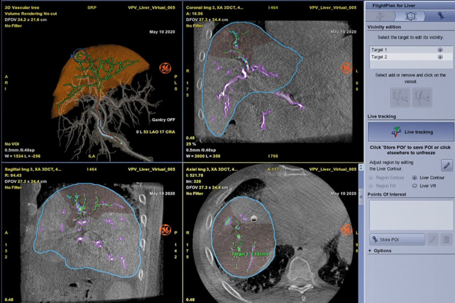 liver-assist-virtual-parenchyma-plan