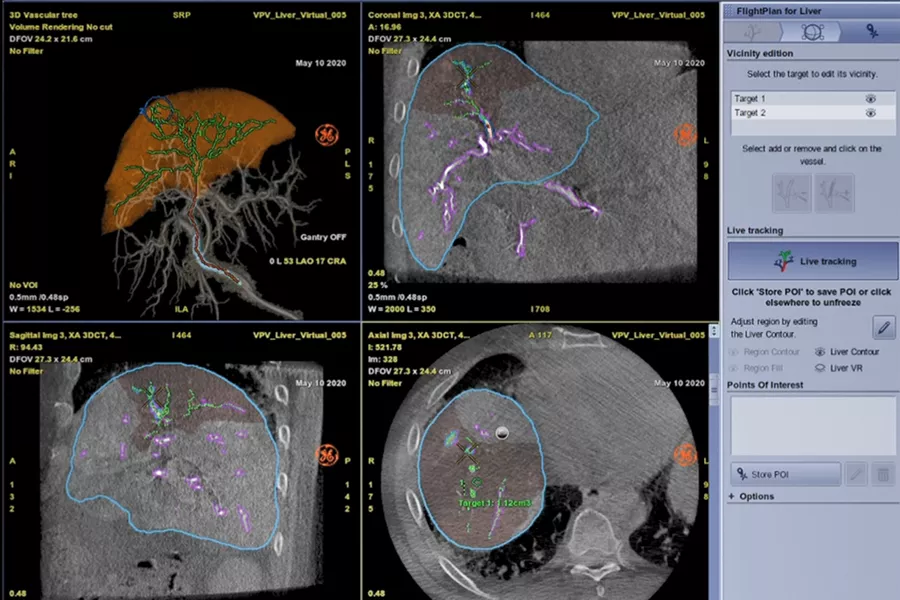 liver-assist-virtual-parenchyma-plan