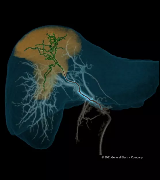 liver-assist-virtual-parenchyma