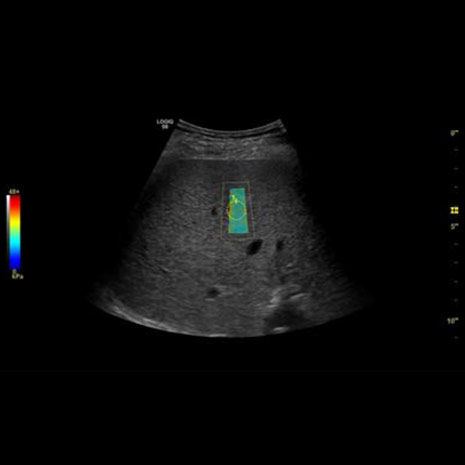 Liver-Shear-Wave-image-using-C1-6-D-probe_465x465