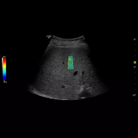 Liver-Shear-Wave-image-using-C1-6-D-probe_465x465