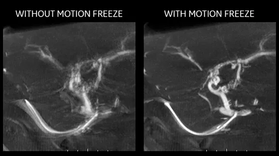 livercare-image-scurve-motionfreezet
