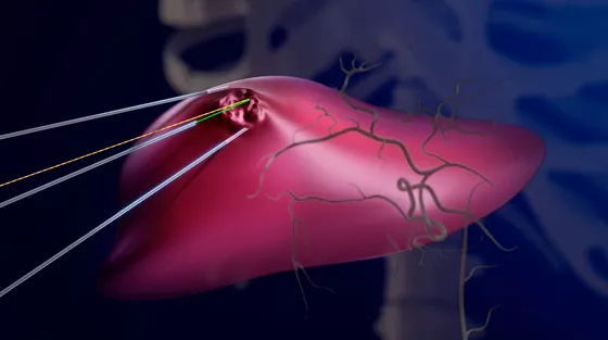 livercare-image-scurve-needleassist
