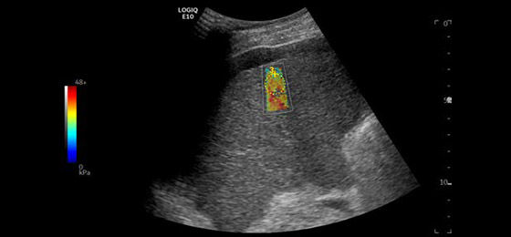 2D Shear Wave Elastography