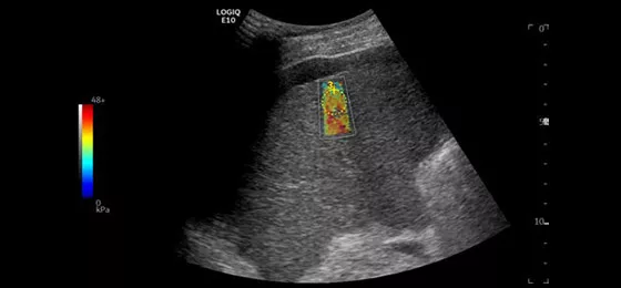 2D Shear Wave Elastography