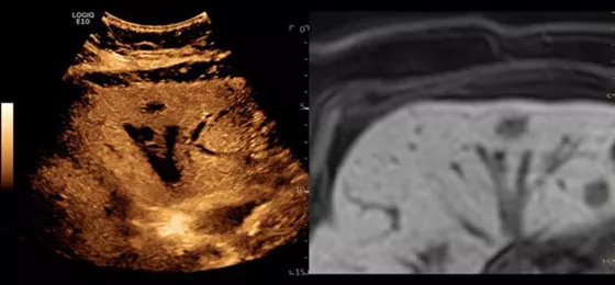 Contrast Enhanced Ultrasound