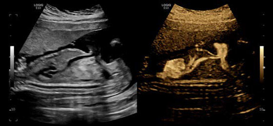 B-Flow� Imaging