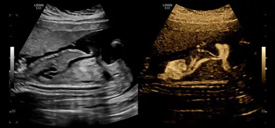 B-Flow� Imaging