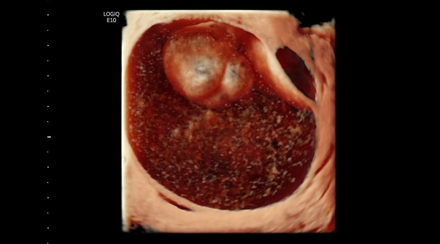 logiq-e10-ge-ultrasound_clinical_case01