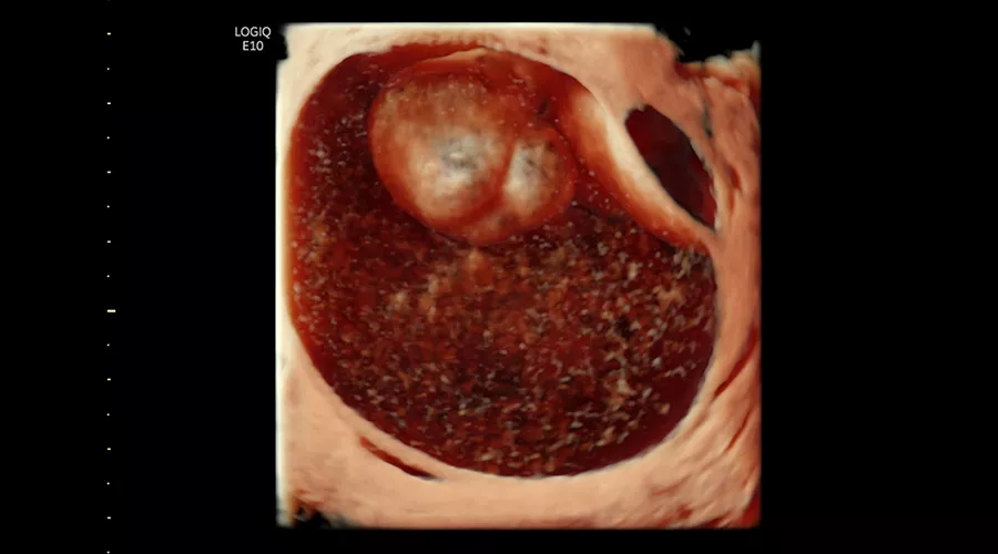 logiq-e10-ge-ultrasound_clinical_case01