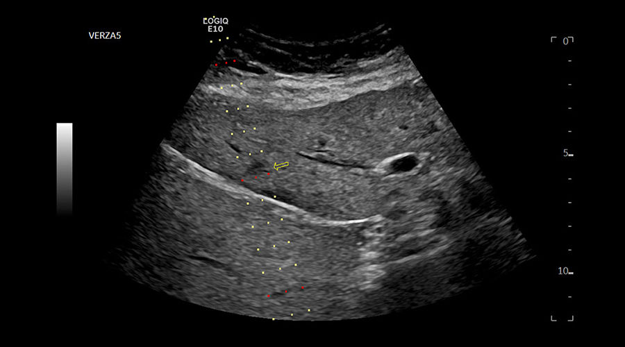 logiq-e10-ge-ultrasound_clinical_case03